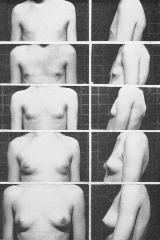 Female_breasts_five_Tanner_stages